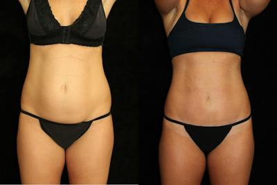 Tummy Tuck Before & After Gallery - Patient 288840 - Image 1