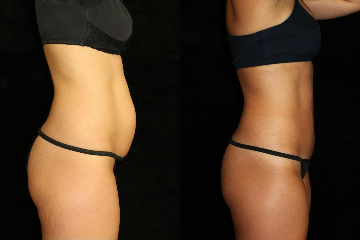 Tummy Tuck Before & After Gallery - Patient 288840 - Image 3