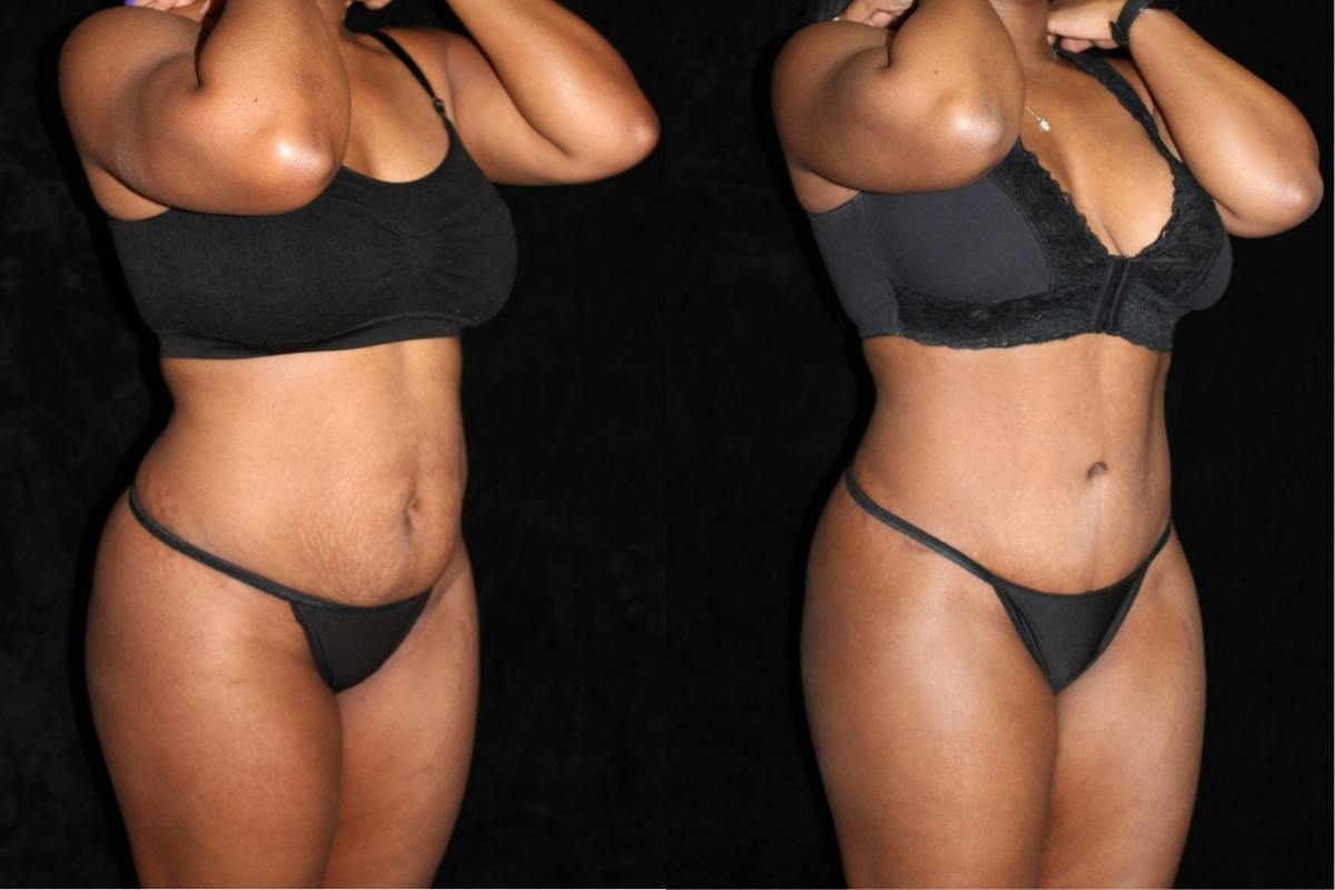 Tummy Tuck Before & After Gallery - Patient 297681 - Image 2