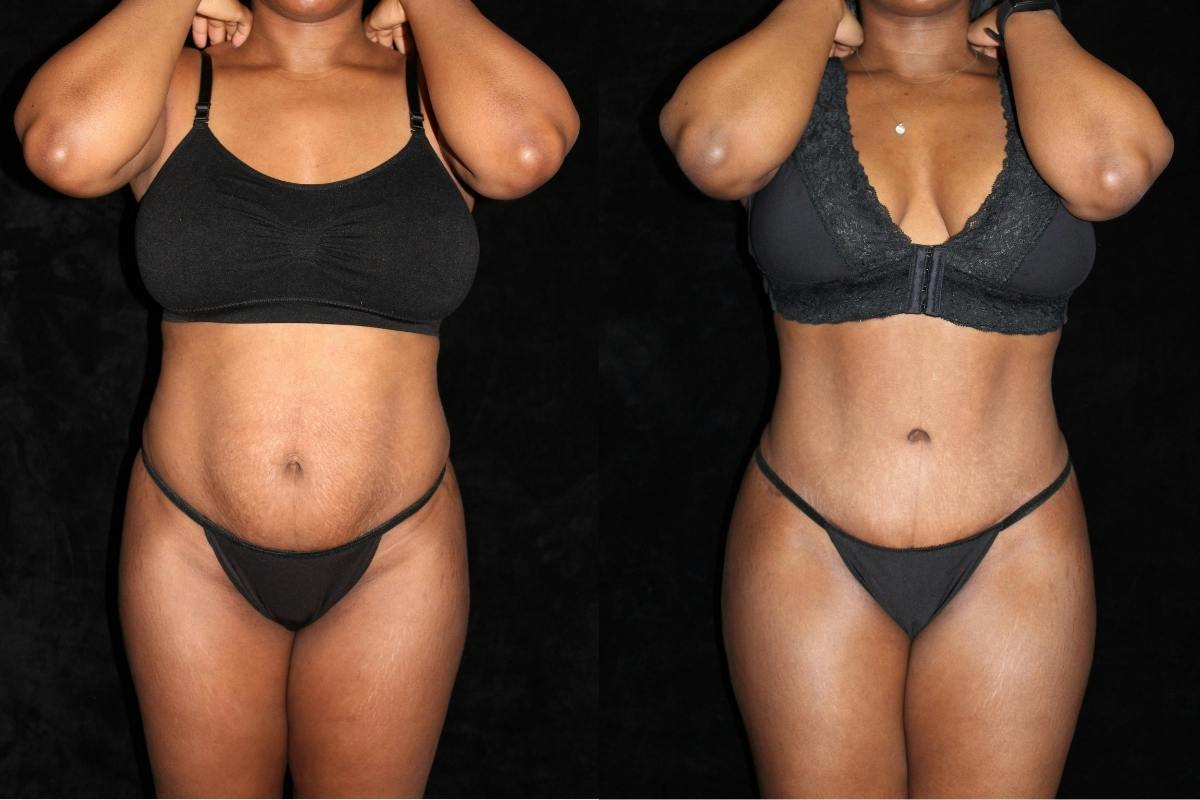 Tummy Tuck Before & After Gallery - Patient 297681 - Image 1