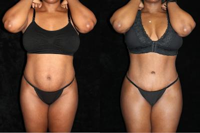Tummy Tuck Before & After Gallery - Patient 297681 - Image 1