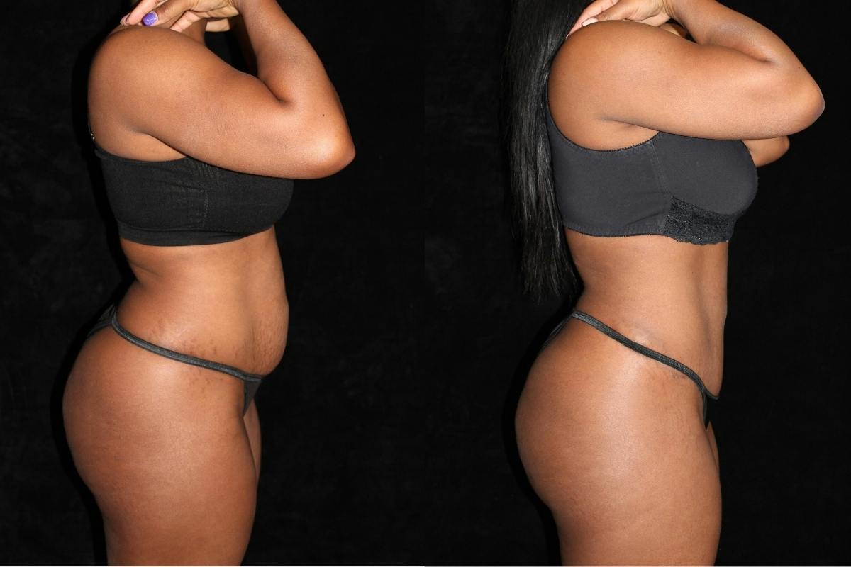 Tummy Tuck Before & After Gallery - Patient 297681 - Image 3