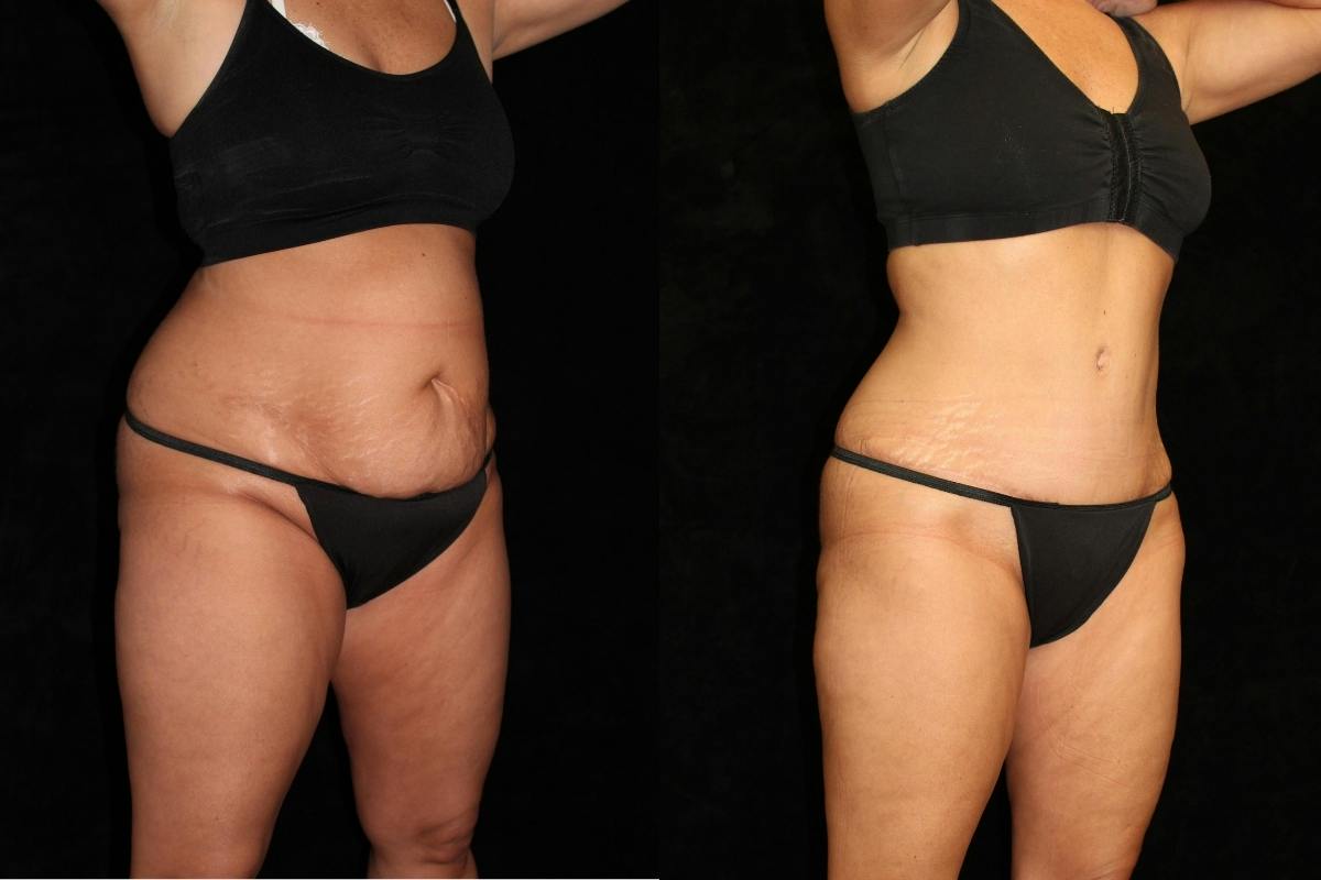 Tummy Tuck Before & After Gallery - Patient 186264 - Image 2
