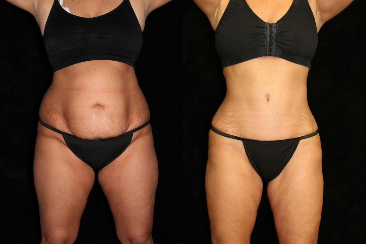 Tummy Tuck Before & After Gallery - Patient 186264 - Image 1