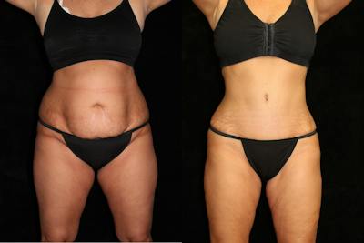 Tummy Tuck Before & After Gallery - Patient 186264 - Image 1