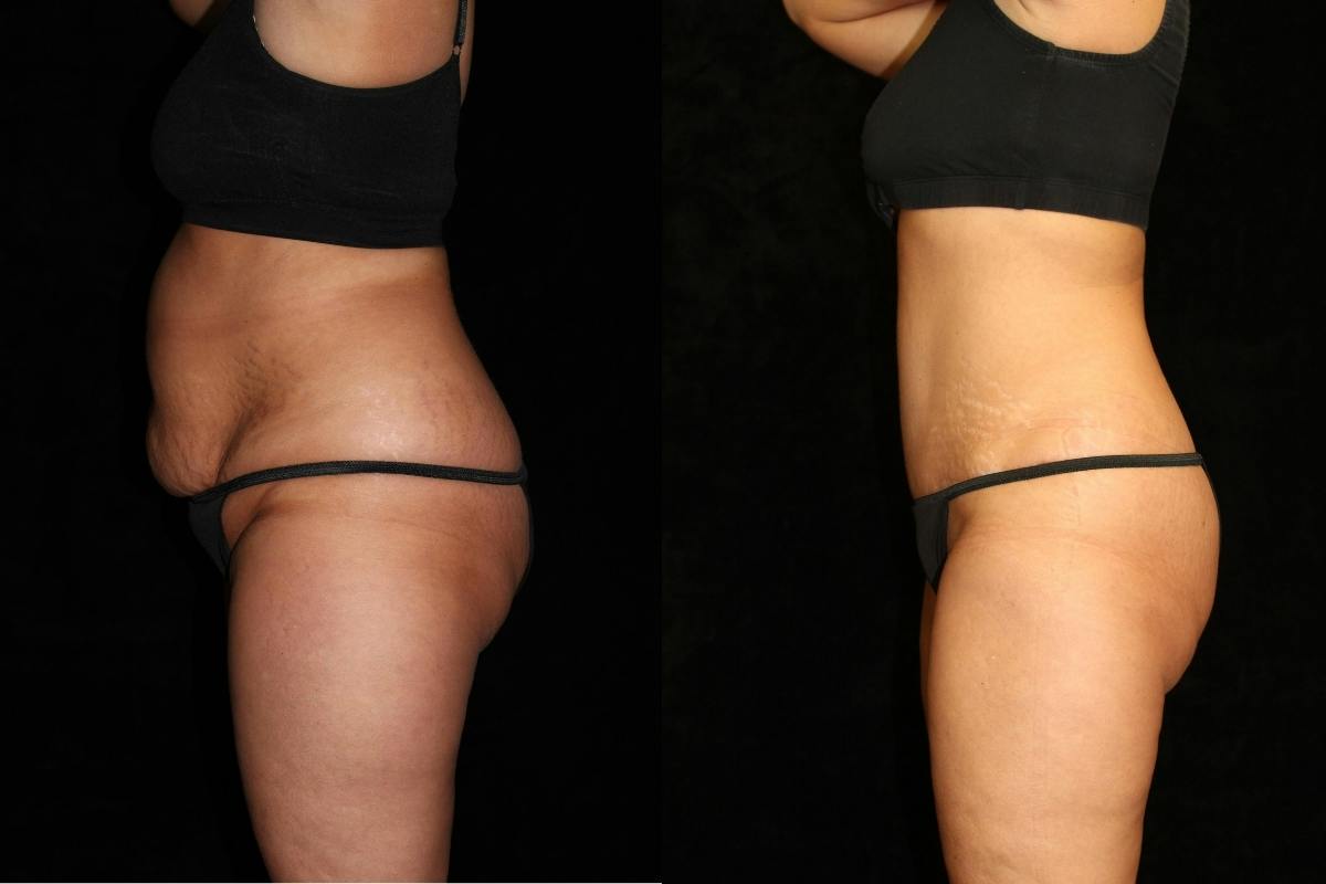 Tummy Tuck Before & After Gallery - Patient 186264 - Image 3