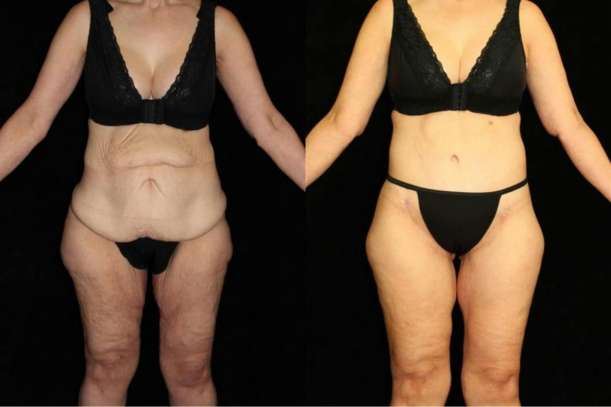 Tummy Tuck Before & After Gallery - Patient 125238 - Image 1