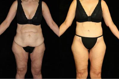 Tummy Tuck Before & After Gallery - Patient 125238 - Image 1