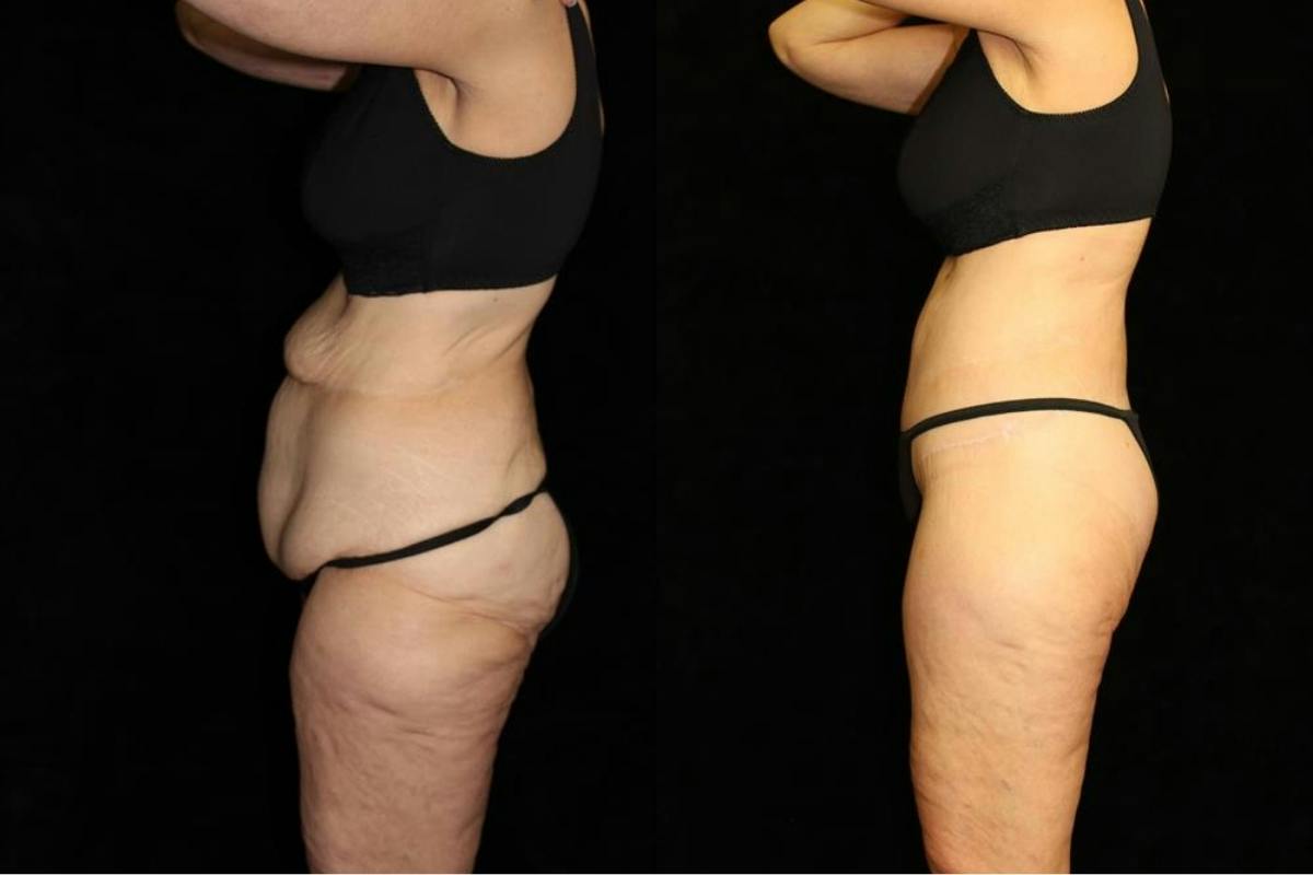 Tummy Tuck Before & After Gallery - Patient 125238 - Image 2