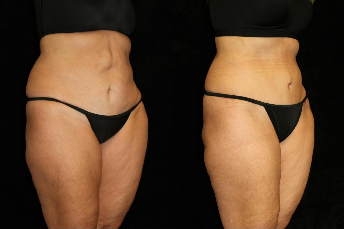 Tummy Tuck Before & After Gallery - Patient 381929 - Image 2
