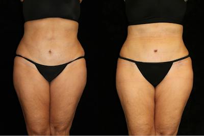 Tummy Tuck Before & After Gallery - Patient 381929 - Image 1