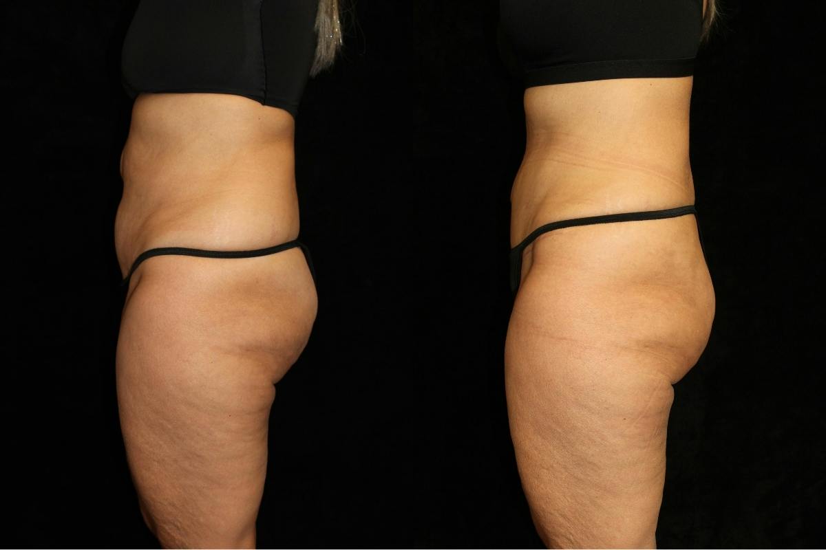 Tummy Tuck Before & After Gallery - Patient 381929 - Image 3