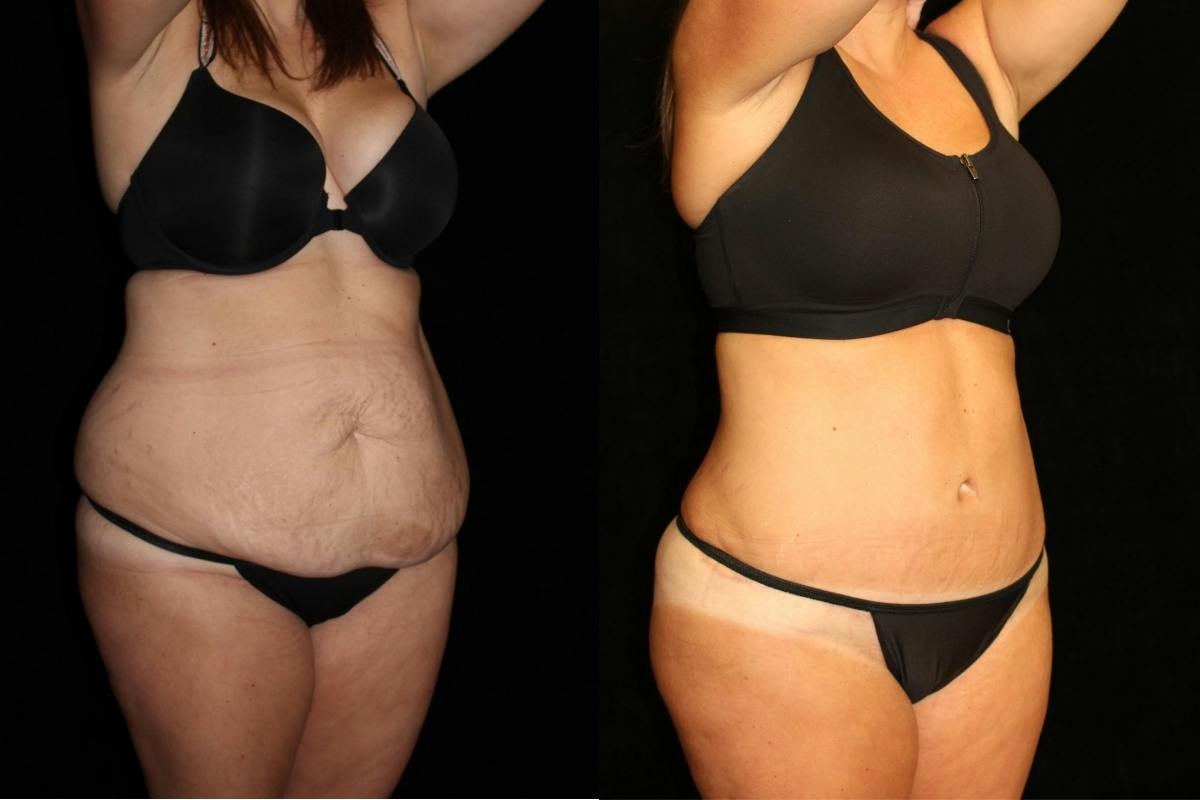 Tummy Tuck Before & After Gallery - Patient 205610 - Image 2