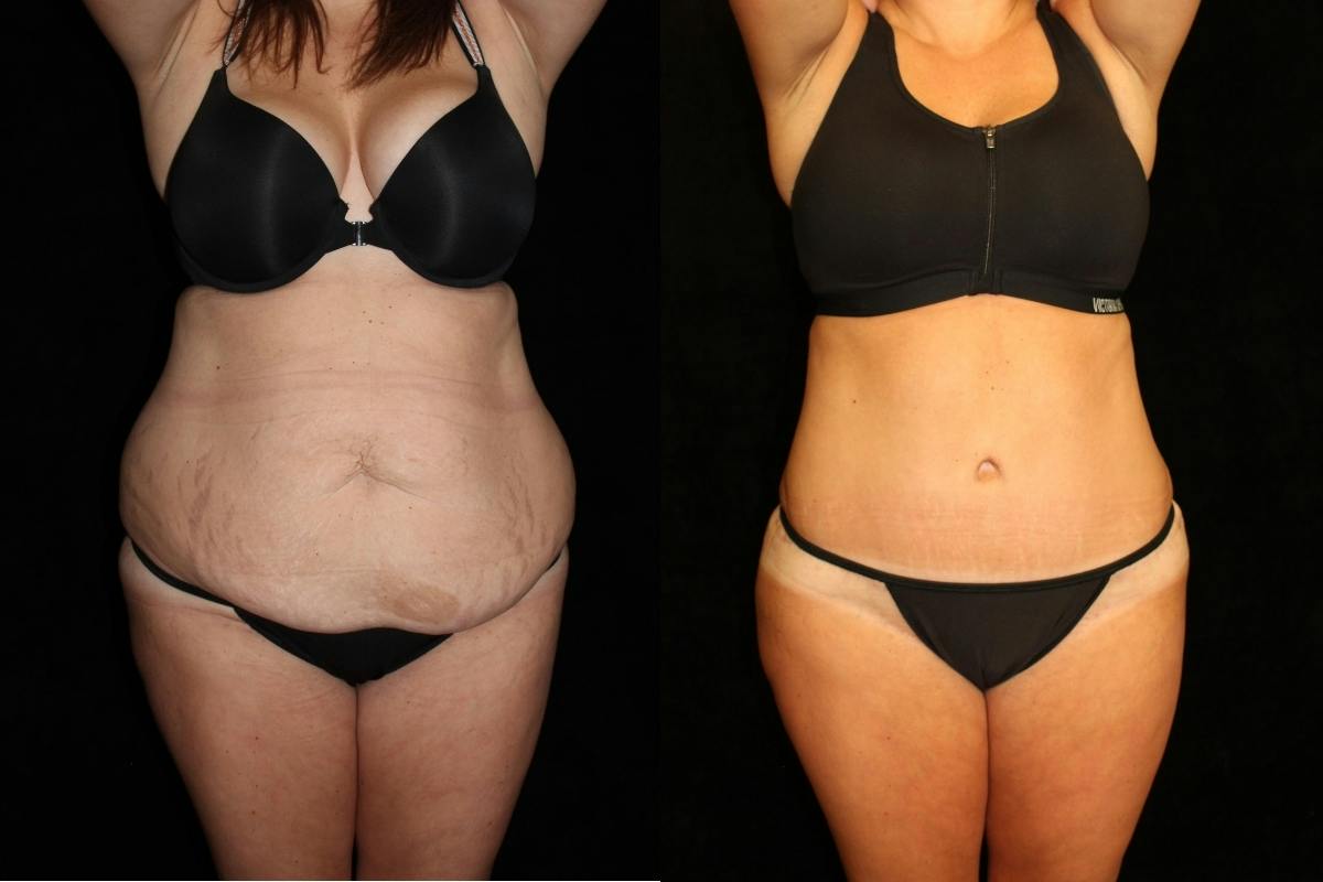 Tummy Tuck Before & After Gallery - Patient 205610 - Image 1