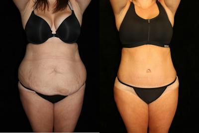 Tummy Tuck Before & After Gallery - Patient 205610 - Image 1