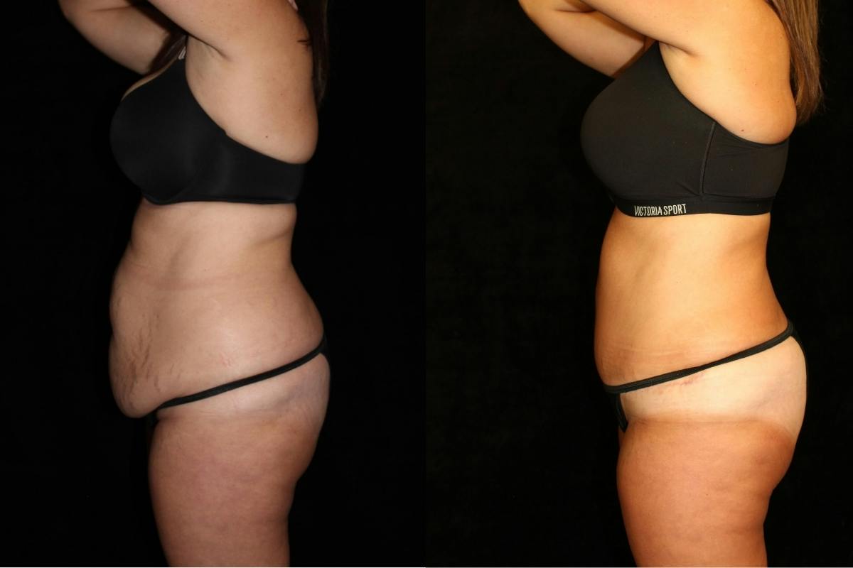 Tummy Tuck Before & After Gallery - Patient 205610 - Image 3