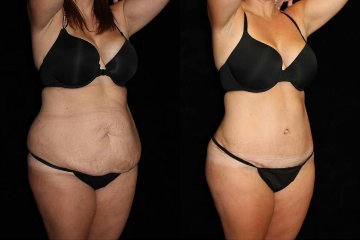 Tummy Tuck Before & After Gallery - Patient 316673 - Image 2