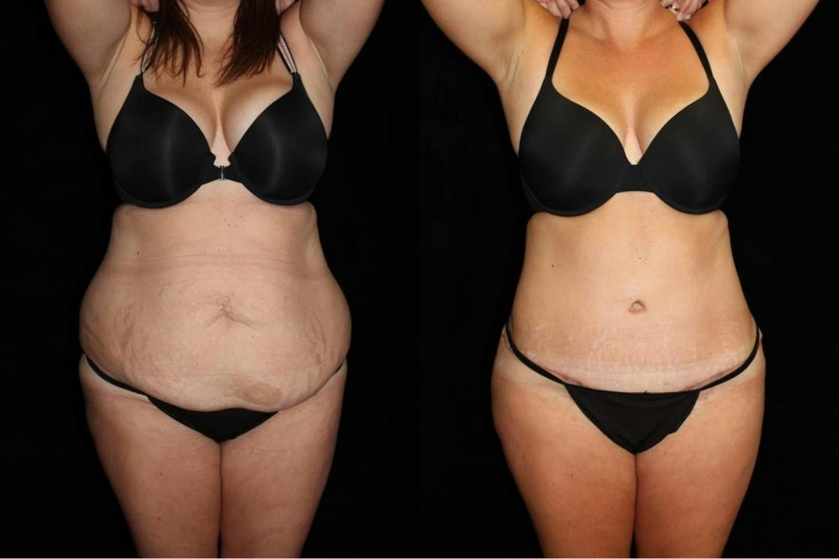 Tummy Tuck Before & After Gallery - Patient 316673 - Image 1