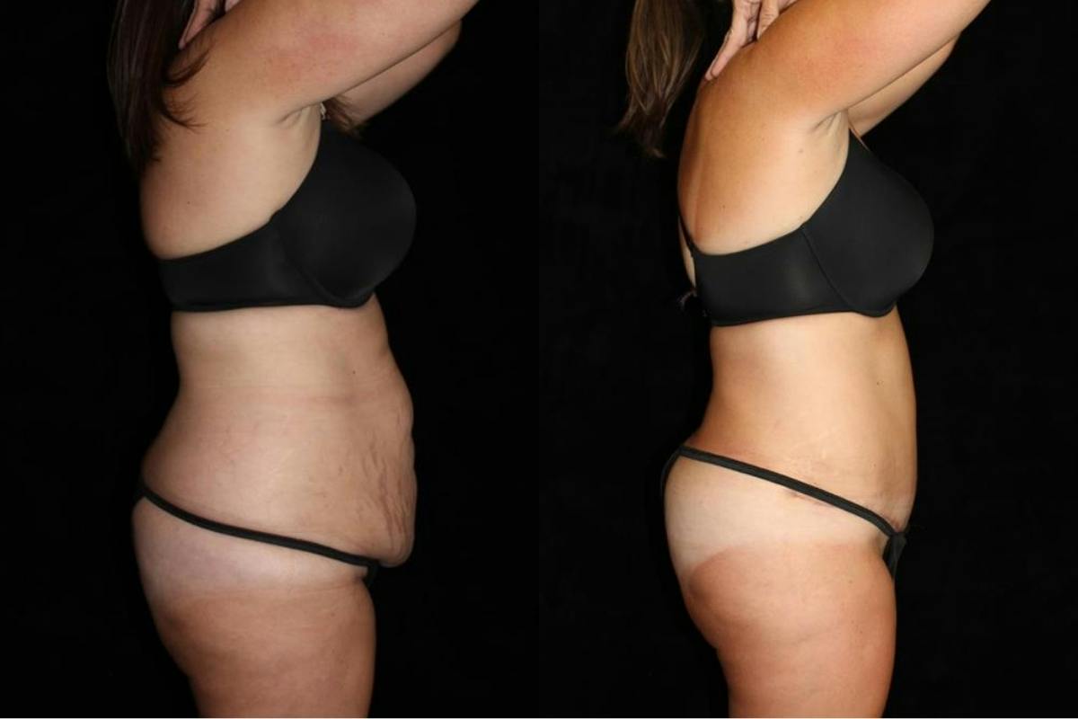 Tummy Tuck Before & After Gallery - Patient 316673 - Image 3