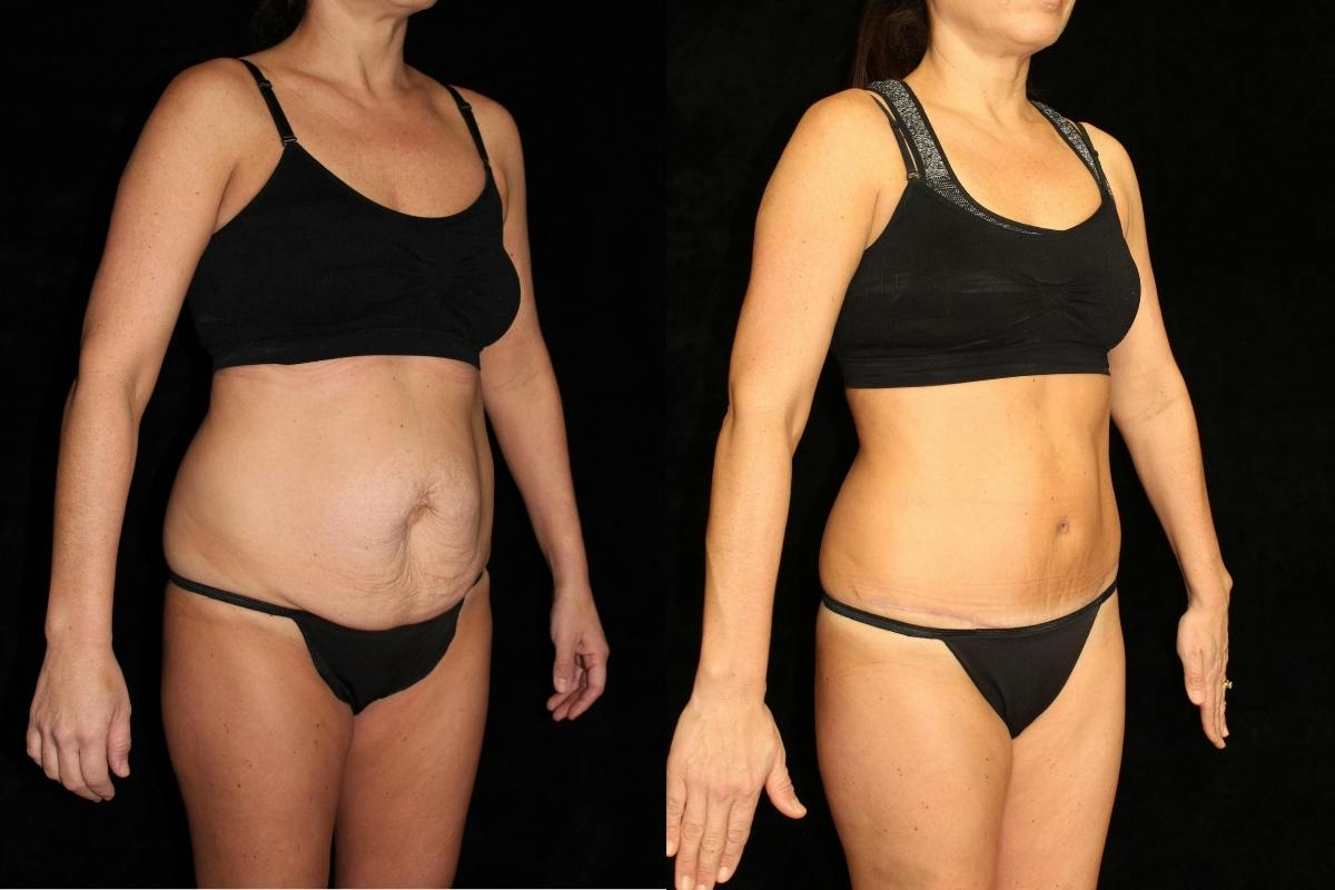 Tummy Tuck Before & After Gallery - Patient 982777 - Image 2