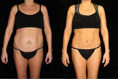 Tummy Tuck Before & After Gallery - Patient 982777 - Image 1