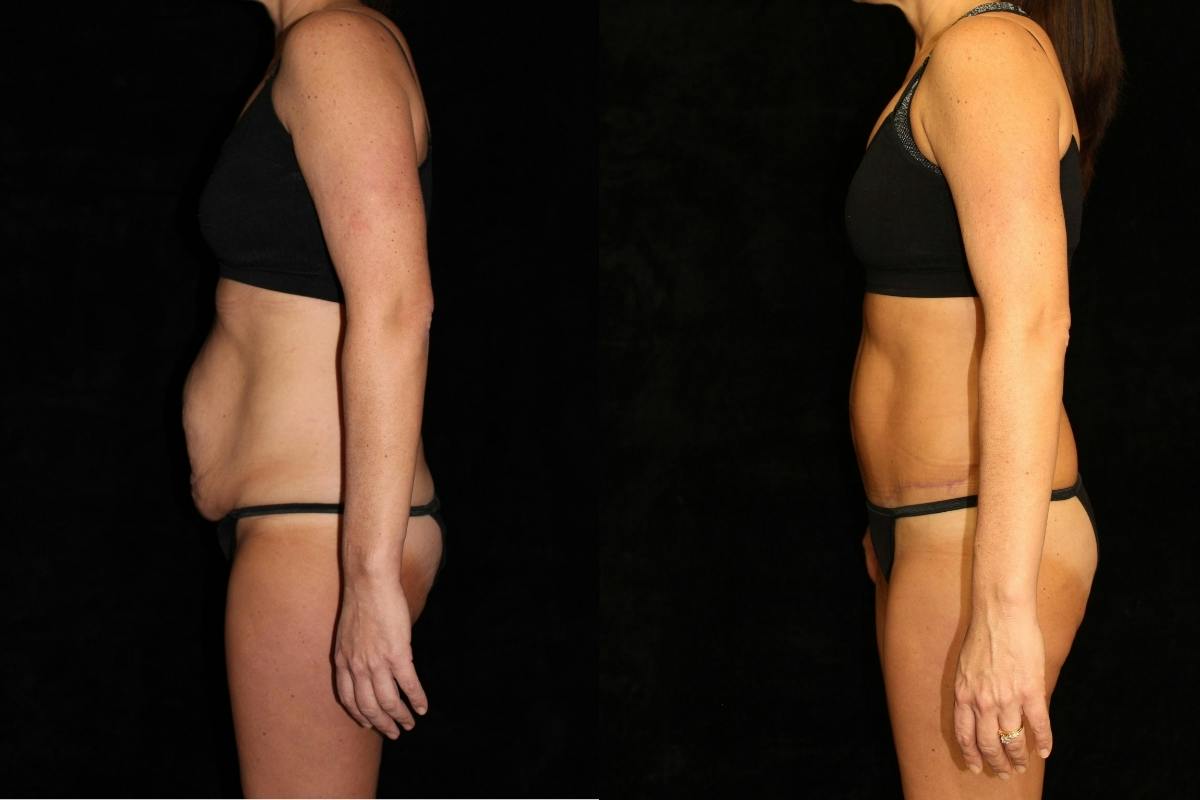Tummy Tuck Before & After Gallery - Patient 982777 - Image 3