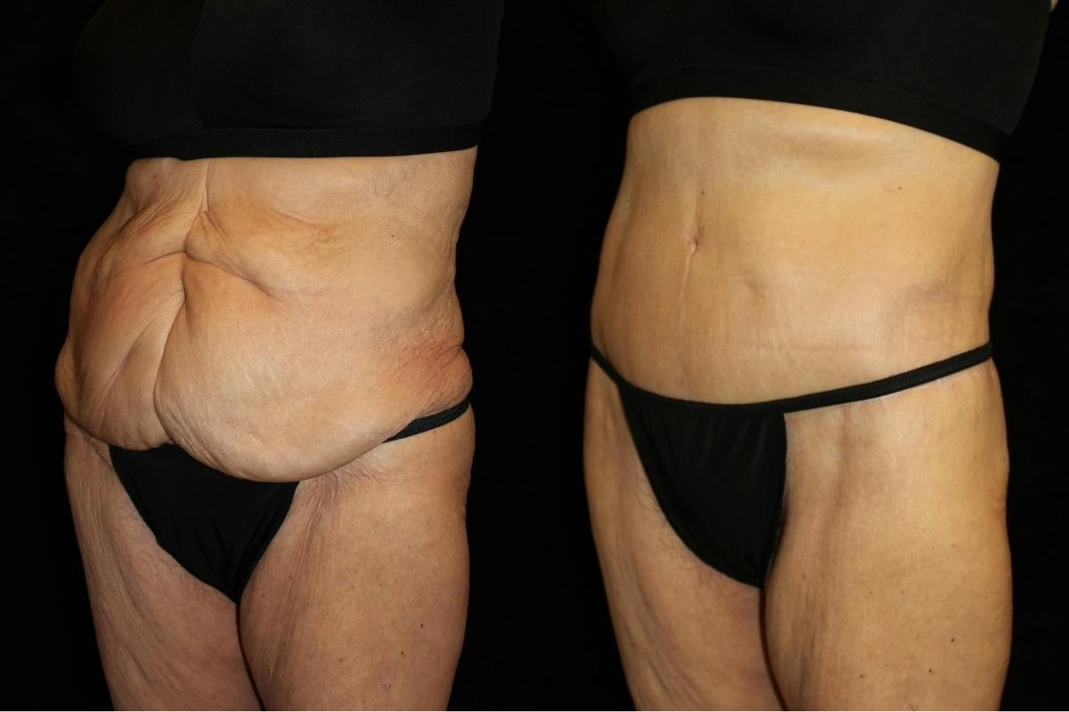 Tummy Tuck Before & After Gallery - Patient 373852 - Image 2