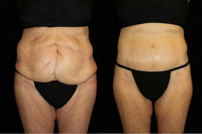 Tummy Tuck Before & After Gallery - Patient 373852 - Image 1