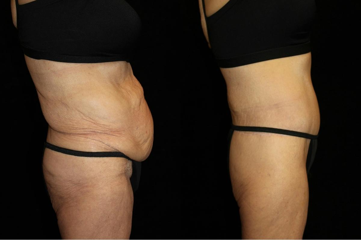 Tummy Tuck Before & After Gallery - Patient 373852 - Image 3