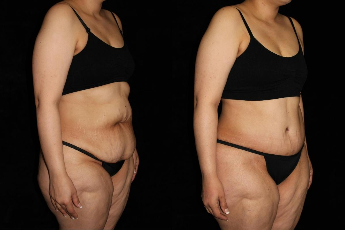 Tummy Tuck Before & After Gallery - Patient 226492 - Image 2