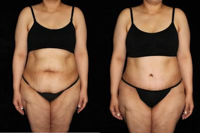 Tummy Tuck Before & After Gallery - Patient 226492 - Image 1
