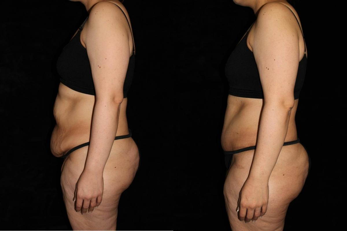 Tummy Tuck Before & After Gallery - Patient 226492 - Image 3