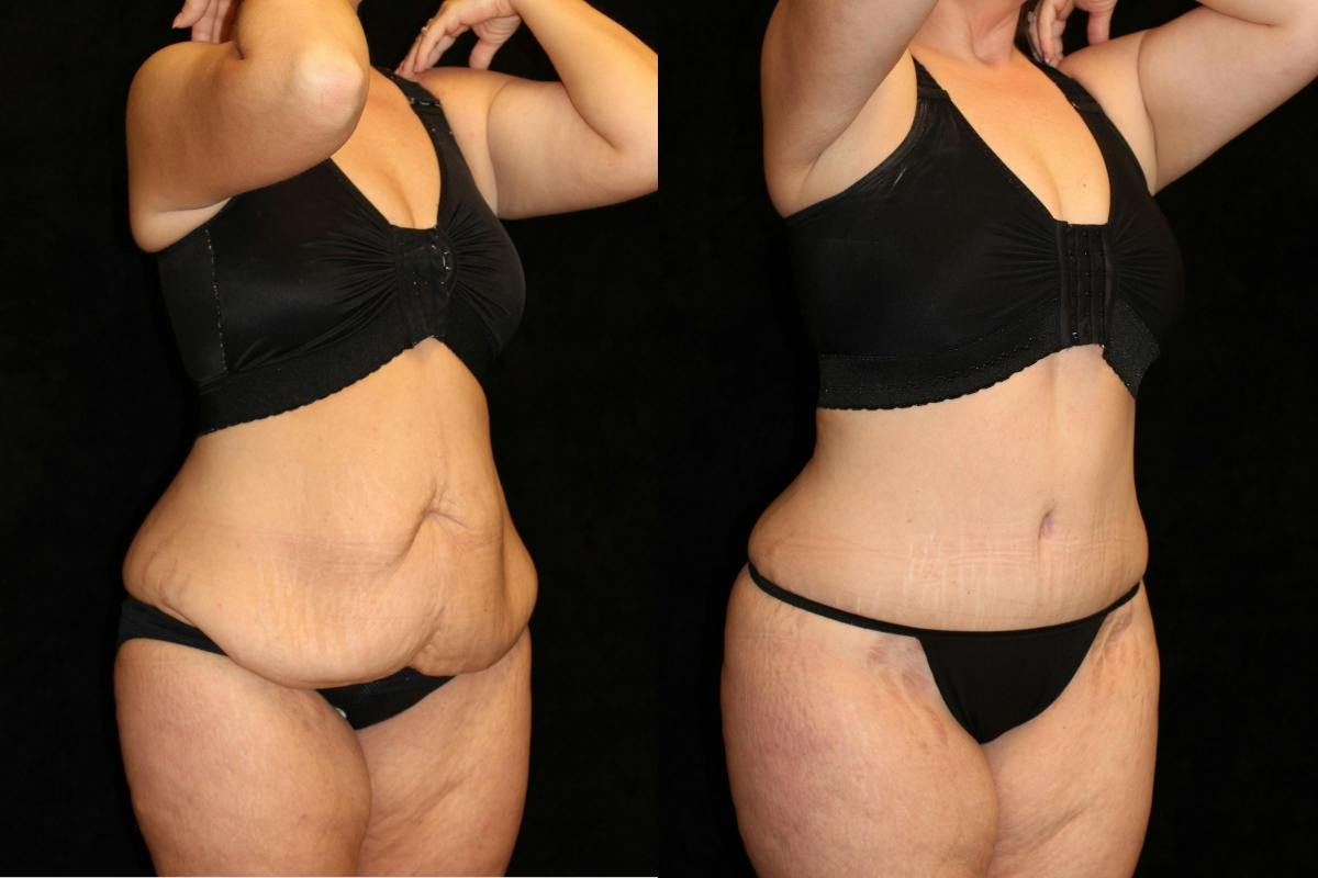 Tummy Tuck Before & After Gallery - Patient 262255 - Image 2