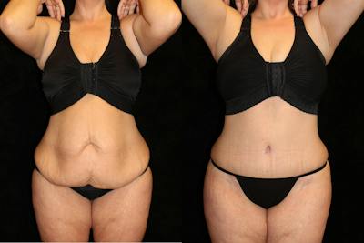 Tummy Tuck Before & After Gallery - Patient 262255 - Image 1