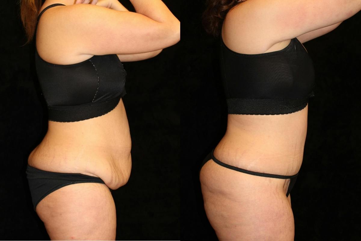 Tummy Tuck Before & After Gallery - Patient 262255 - Image 3