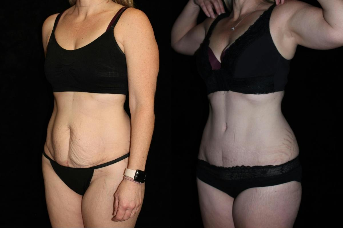 Tummy Tuck Before & After Gallery - Patient 239410 - Image 2