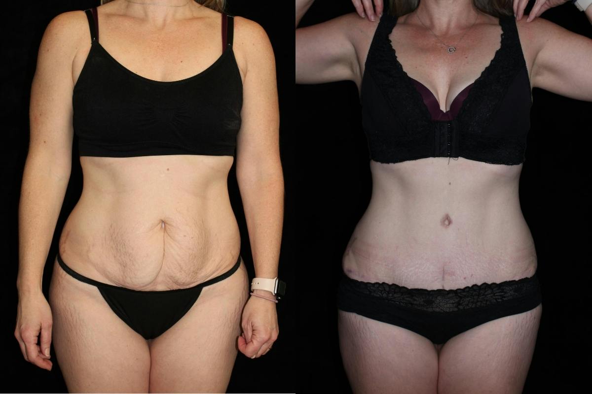Tummy Tuck Before & After Gallery - Patient 239410 - Image 1