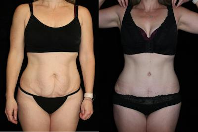 Tummy Tuck Before & After Gallery - Patient 239410 - Image 1