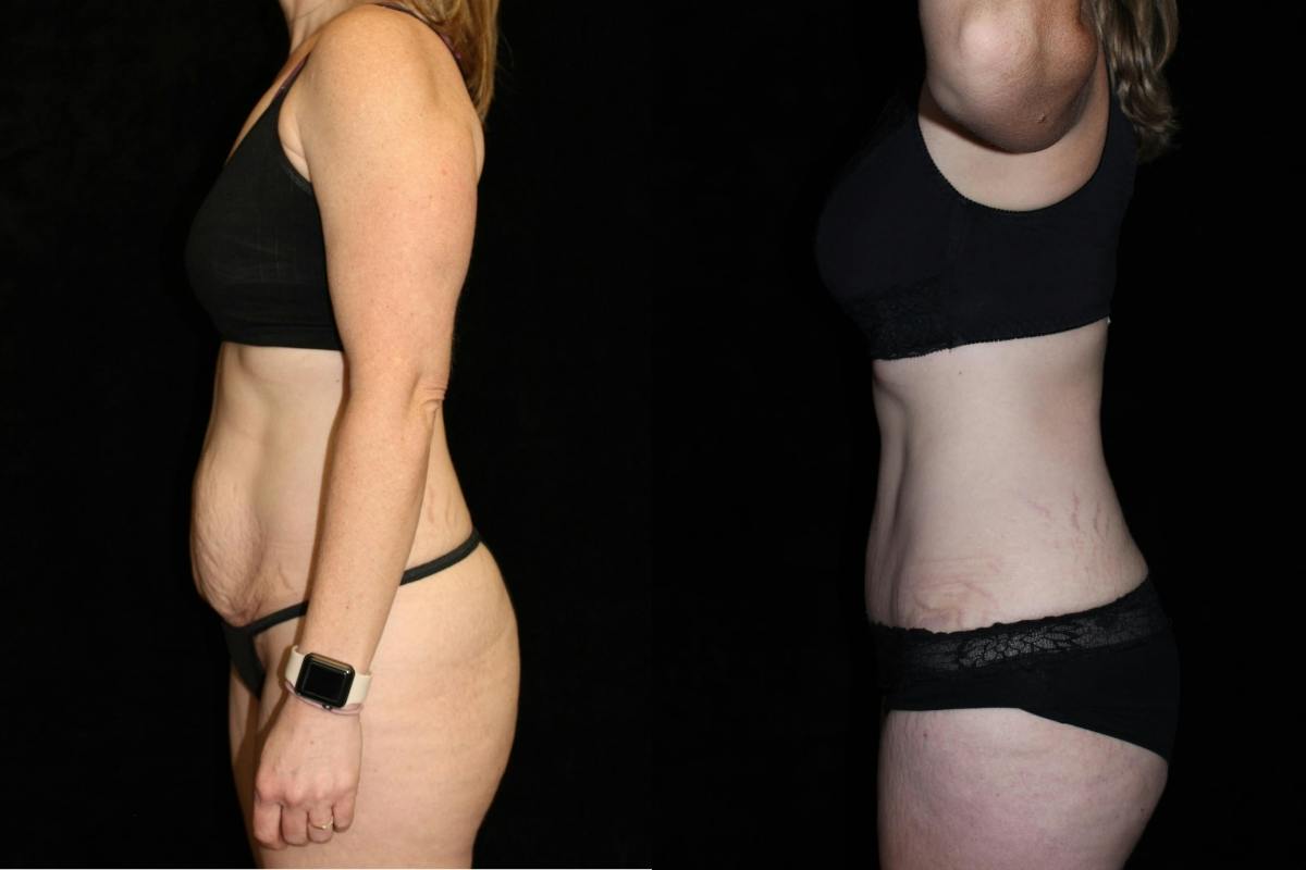 Tummy Tuck Before & After Gallery - Patient 239410 - Image 3