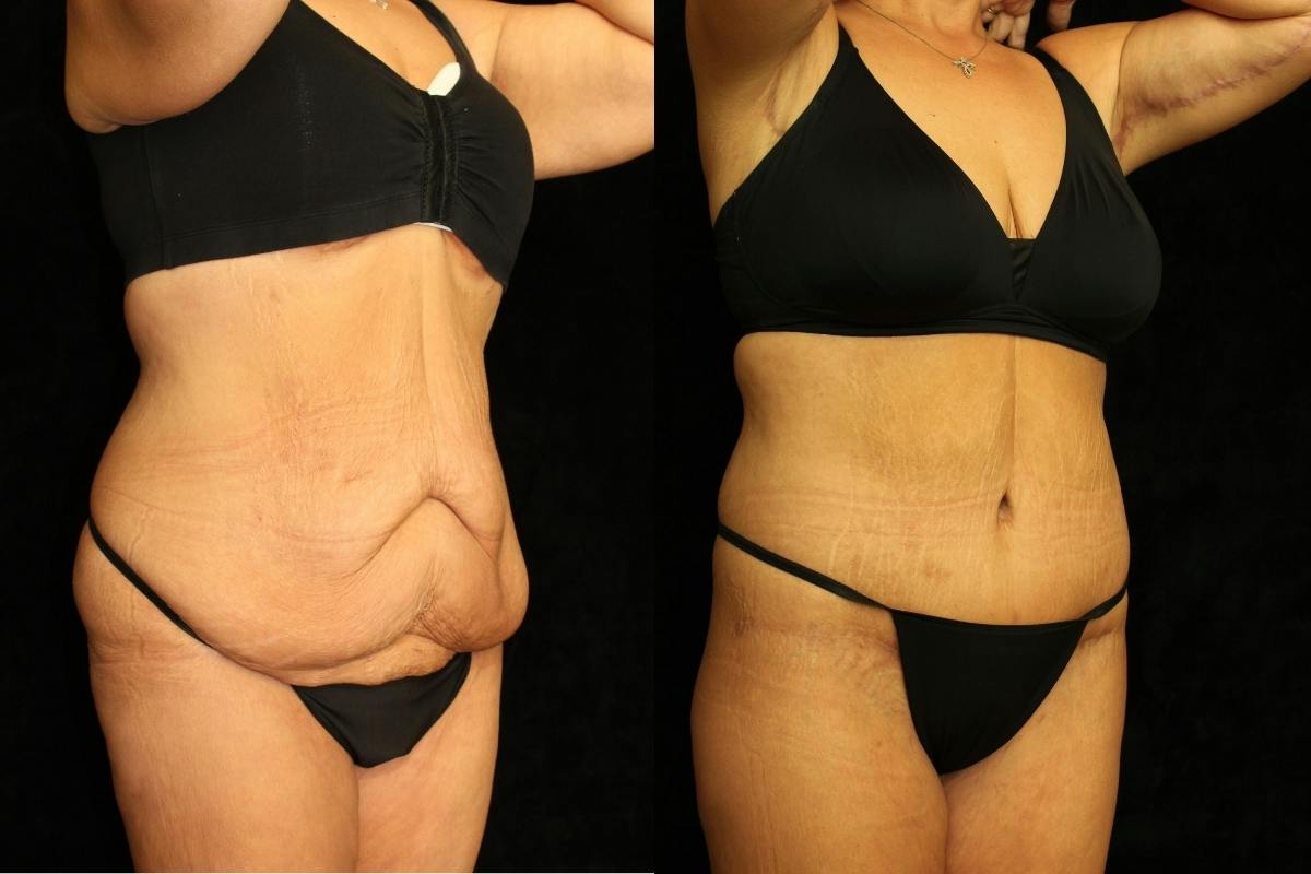 Tummy Tuck Before & After Gallery - Patient 257646 - Image 2