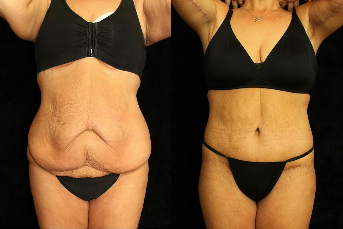 Tummy Tuck Before & After Gallery - Patient 257646 - Image 1