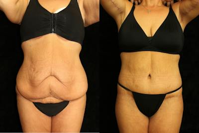 Tummy Tuck Before & After Gallery - Patient 257646 - Image 1
