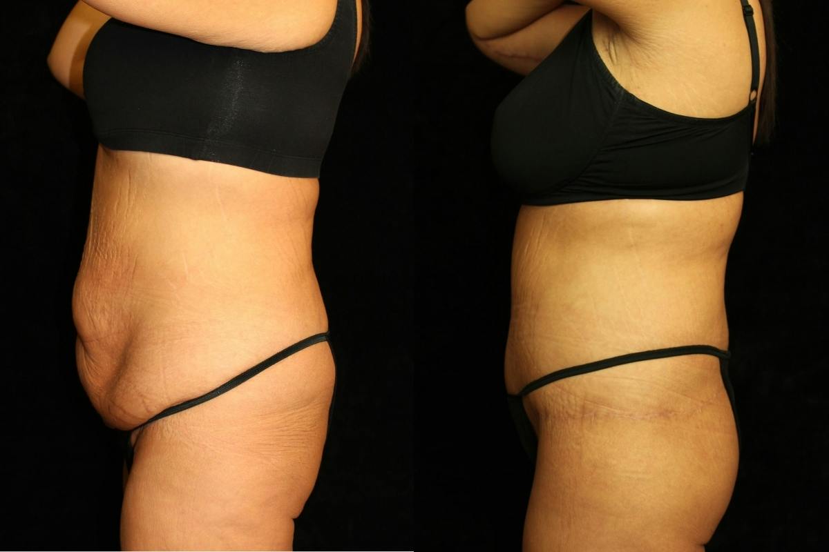 Tummy Tuck Before & After Gallery - Patient 257646 - Image 3