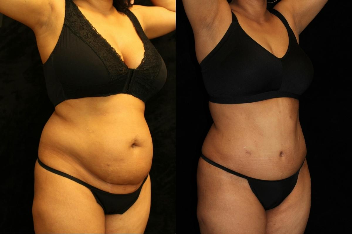 Tummy Tuck Before & After Gallery - Patient 831124 - Image 2