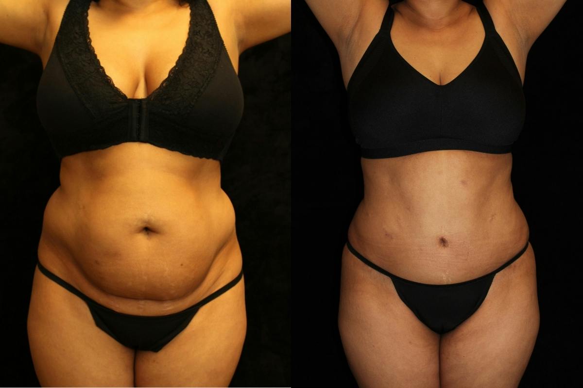 Tummy Tuck Before & After Gallery - Patient 831124 - Image 1
