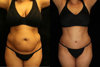 Tummy Tuck Before & After Gallery - Patient 831124 - Image 1