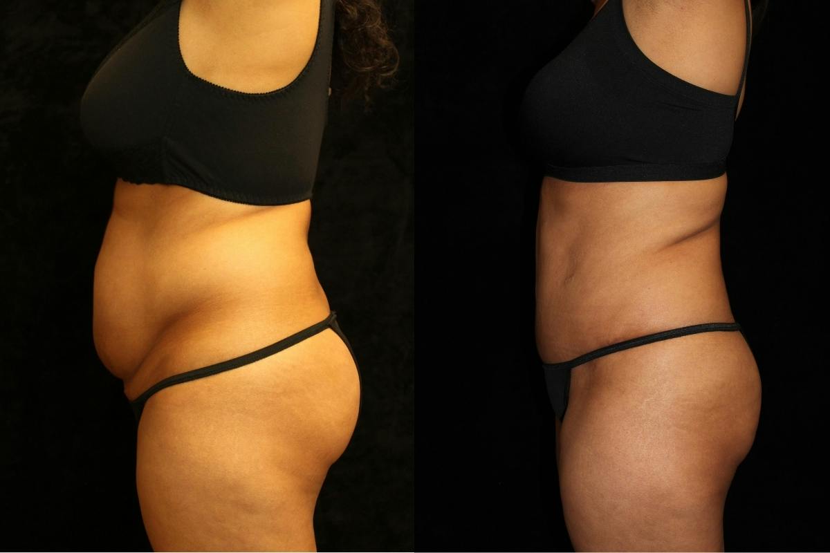 Tummy Tuck Before & After Gallery - Patient 831124 - Image 3