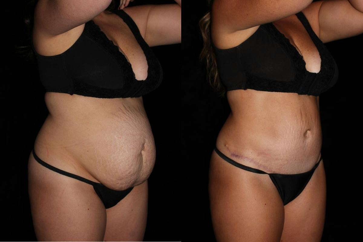 Tummy Tuck Before & After Gallery - Patient 351505 - Image 2