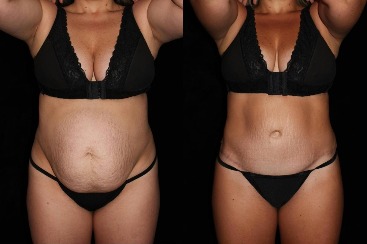 Tummy Tuck Before & After Gallery - Patient 351505 - Image 1