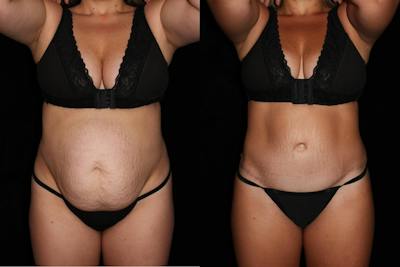 Tummy Tuck Before & After Gallery - Patient 351505 - Image 1